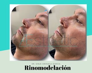 Antes y después de Rinomodelación con ácido hialuronico 