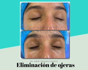 Ojeras antes/después - Dr. Sinué Orihuela García