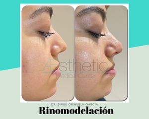 Rinomodelación con ácido hialuronico - Dr. Sinué Orihuela García