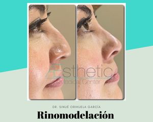 Rinomodelación - Dr. Sinué Orihuela García