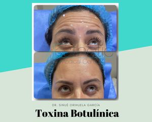 Antes y después de Toxina Botulínica 