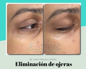 Eliminación de ojeras - Dr. Sinué Orihuela García