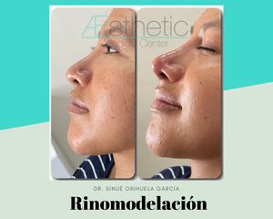 Antes y después de Rinomodelación con ácido hialuronico
