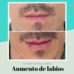 Antes y después de Aumento de labios con acido hialuronico