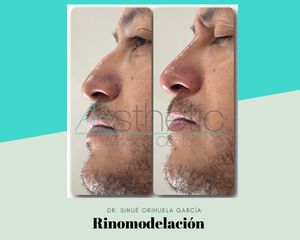 Antes y después de Rinomodelación con ácido hialuronico