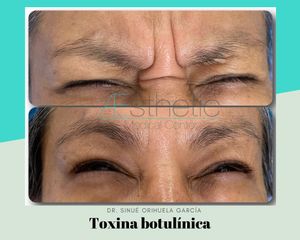 Antes y después de Toxina botulínica