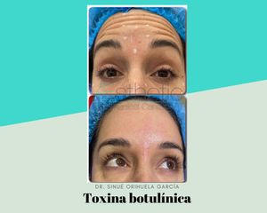 Antes y después de Toxina botulínica