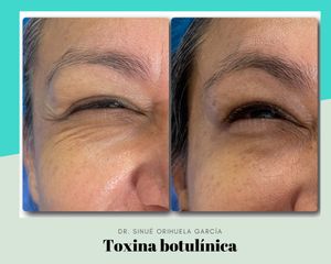 Toxina Botulínica - Dr. Sinué Orihuela García