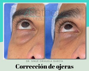 Corrección de ojeras - Dr. Sinué Orihuela García