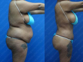 Tummy tuck