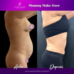 Mommy Makeover - Dra. M. Liliana Aguirre Cázarez