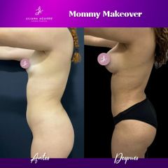 Mommy Makeover - Dra. M. Liliana Aguirre Cázarez