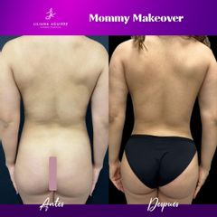 Mommy Makeover - Dra. M. Liliana Aguirre Cázarez