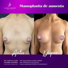 Aumento de busto - Dra. M. Liliana Aguirre Cázarez