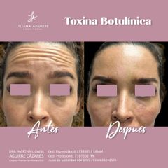 Toxina Botulínica  - Dra. M. Liliana Aguirre Cázarez