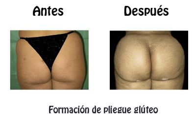 Antes y después de Gluteoplastia