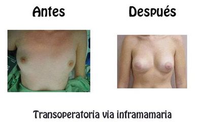 Antes y después de Aumento de busto