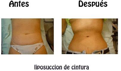 Antes y después de Abdominoplastia