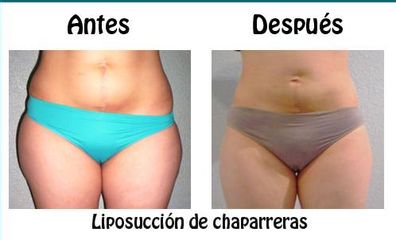 Antes y después de Liposucción