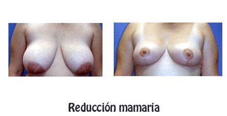 Antes y después de Reducción de mamas