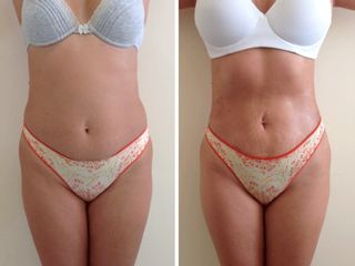 Antes y después de Mesoterapia