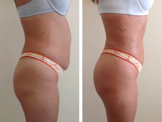 Antes y después de Mesoterapia