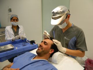 Microinjerto de cabello