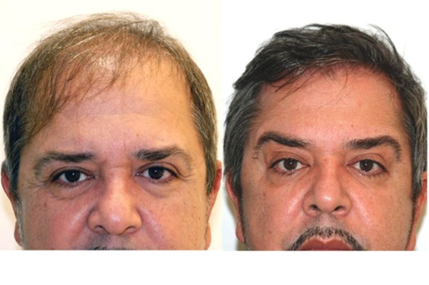 Trasplante de cabello antes y después - 497985