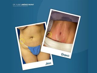 Abdominoplastia - Dr. Yusef Jiménez Murat