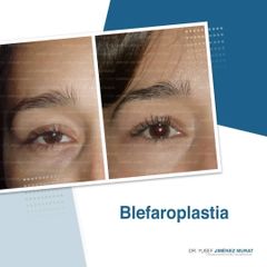 Blefaroplastia - Dr. Yusef Jiménez Murat