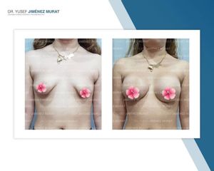 Aumento de busto - Dr. Yusef Jiménez Murat