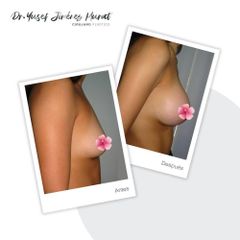 Aumento de busto - Dr. Yusef Jiménez Murat