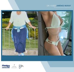 Liposucción - Dr. Yusef Jiménez Murat