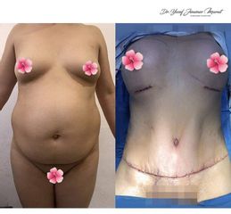 Lipoescultura - Dr. Yusef Jiménez Murat