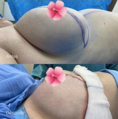 Reducción de mamas - Dr. Yusef Jiménez Murat