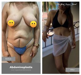 Abdominoplastia - Dr. Yusef Jiménez Murat