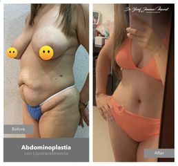 Abdominoplastia - Dr. Yusef Jiménez Murat
