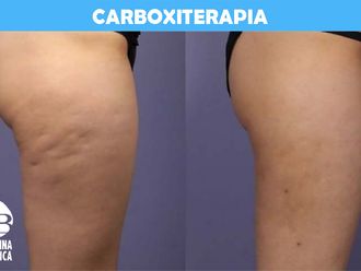 Carboxiterapia antes y después - 788900