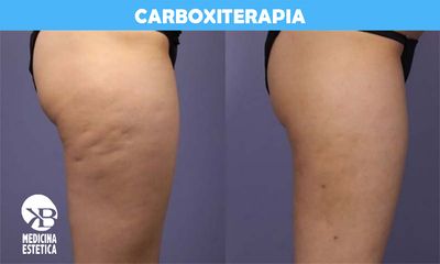 Carboxiterapia - Dra. Karen Badias Mayer