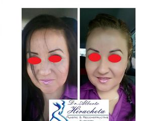 Antes y después de Bichectomia