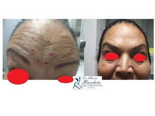 Antes y después de toxina botulínica