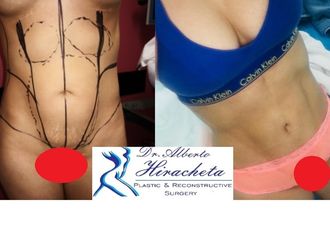 Lipoescultura - 634920