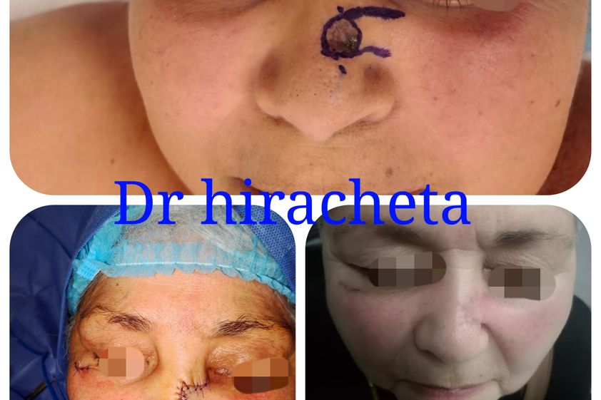 Carcinoma Basocelular antes y después - 739824