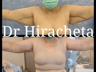 Braquioplastia antes y después - 793320