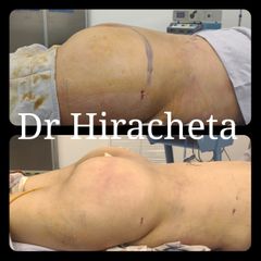 Antes y después de Gluteoplastia BBL 