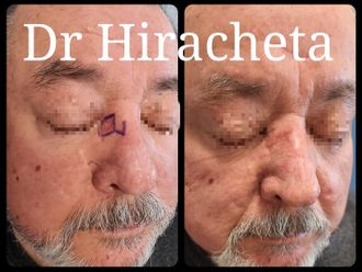 Carcinoma Basocelular antes y después - 816001