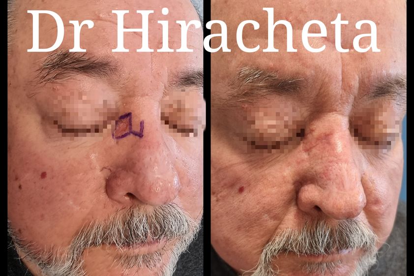 Carcinoma Basocelular antes y después - 816001