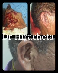 Antes y después de Reconstrucción auricular 
