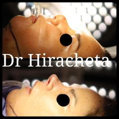 Rinoplastia - Dr. Alberto Hiracheta