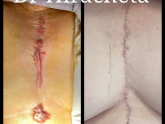 Eliminación de cicatrices antes y después - 846256